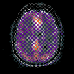 Herpes Encephalitis: MRI/SPECT overlay -- Slice #20